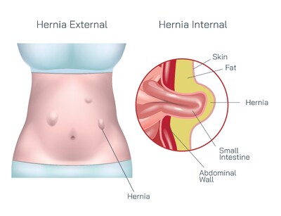 Abdominal Hernia Explained – Causes, Symptoms, Types, Diagnosis, and Treatment Options