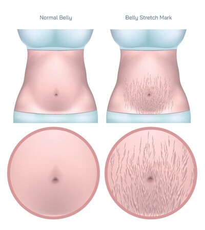 Belly Stretch Marks Explained – Reasons, Causes, Symptoms, Treatment, Diet, and Skin Care